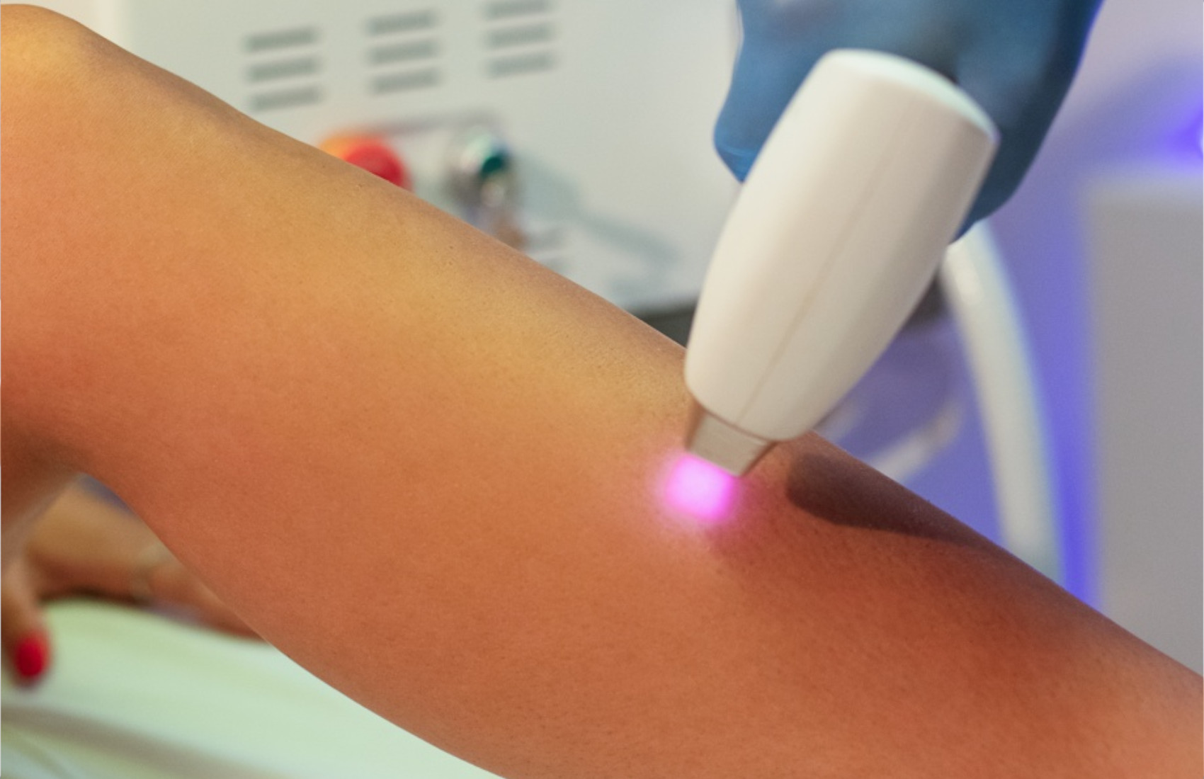 3 sedute di epilazione laser zona grande -87% di sconto